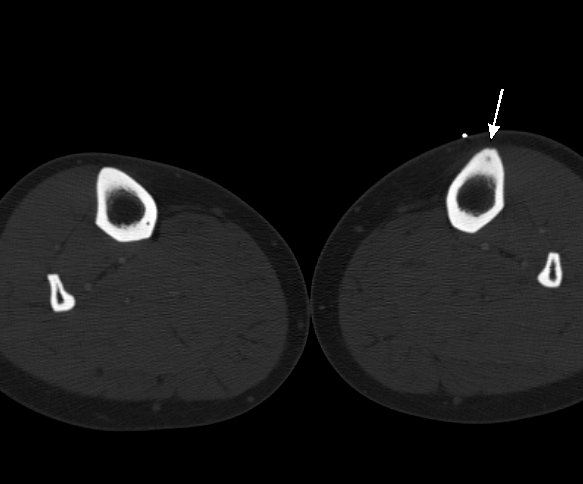 Figure 2 for case osteoid osteoma ( RID4005 )